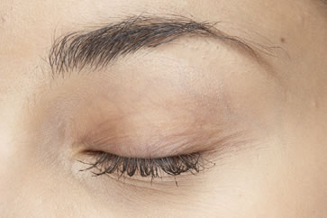 Blefaroplastia o cirugía de los párpados. Párpado.